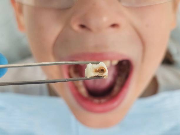Best Emergency Tooth Extraction in Mystic Island, NJ